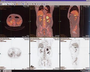 大腸癌の肝転移（上：PET-CT 下：PET）